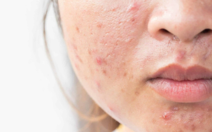 Mụn trứng cá Mụn trứng cá - Ảnh 2.