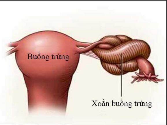 Xoắn U Nang Buồng Trứng: Dấu Hiệu Cảnh Báo và Biện Pháp Cứu Khẩn