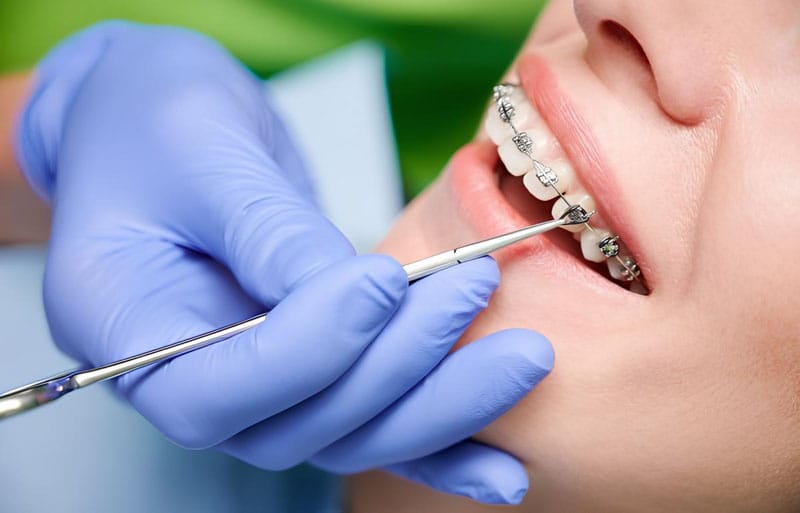 Niềng răng bị hóp má: Nguyên nhân và cách khắc phục hiệu quả- Ảnh 2.