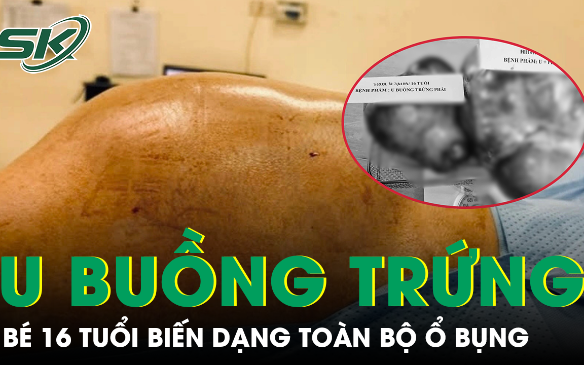 Cẩn Trọng Với Khối U Buồng Trứng: Triệu Chứng và Cách Nhận Biết
