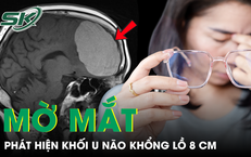 Khi nặn mụn lộ giun dưới da dài 20cm: hướng xử trí an toàn