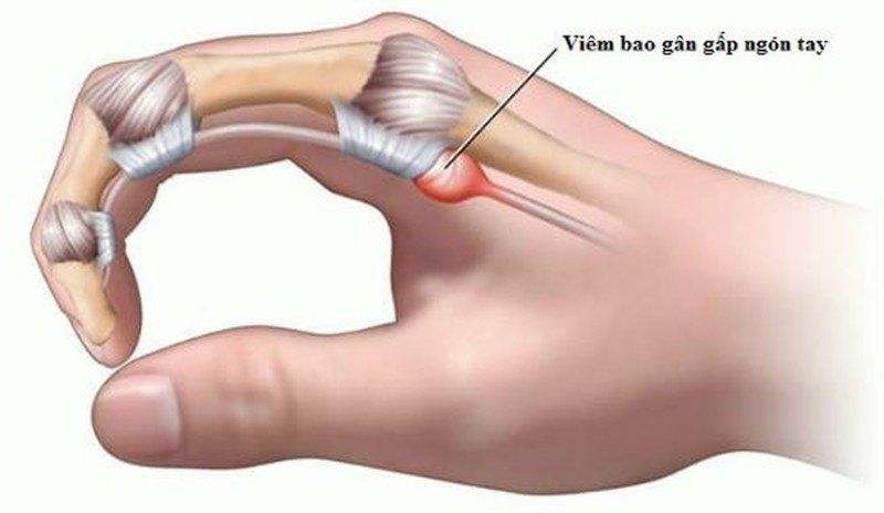 Hiểu Biết Về Viêm Gân Gấp Ngón Tay: Nguyên Nhân, Dấu Hiệu và Cách Phòng Ngừa