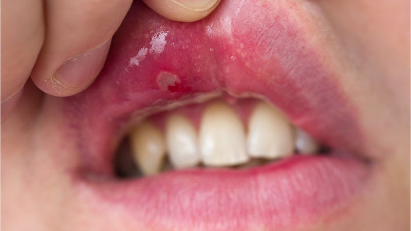 Hình ảnh minh họa cho tình trạng sức khỏe răng miệng của bệnh nhân Lupus ban đỏ