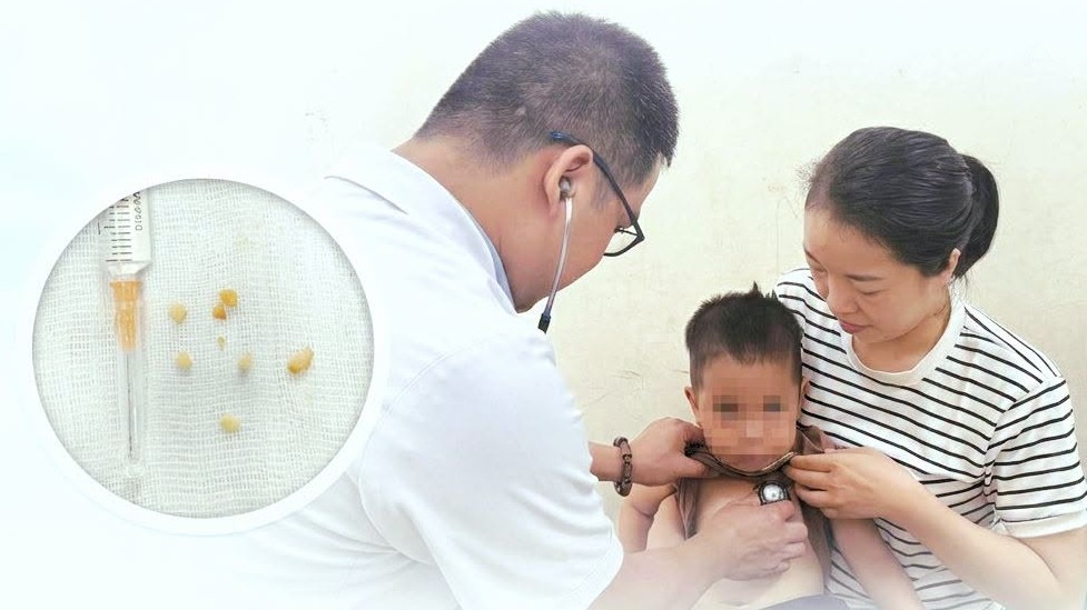 Cứu sống bé 2 tuổi bị tắc hai bên phế quản do mảnh hạt lạc: bài học xử trí khẩn cấp