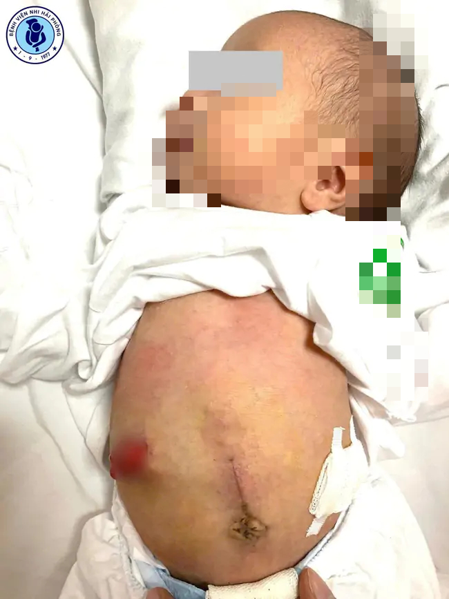 Hành Trình Cứu Sống Trẻ Sơ Sinh Tại Bệnh Viện Nhi Hải Phòng: Một Ca Phẫu Thuật Đầy Thách Thức