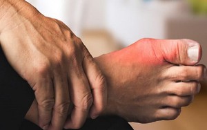 Cách Chạy Bộ An Toàn Cho Người Bị Gout Để Tránh Tái Phát