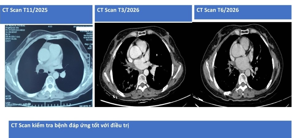 Trường Hợp Đáng Chú Ý Về Ung Thư Phổi Tại Bệnh Viện Đà Nẵng