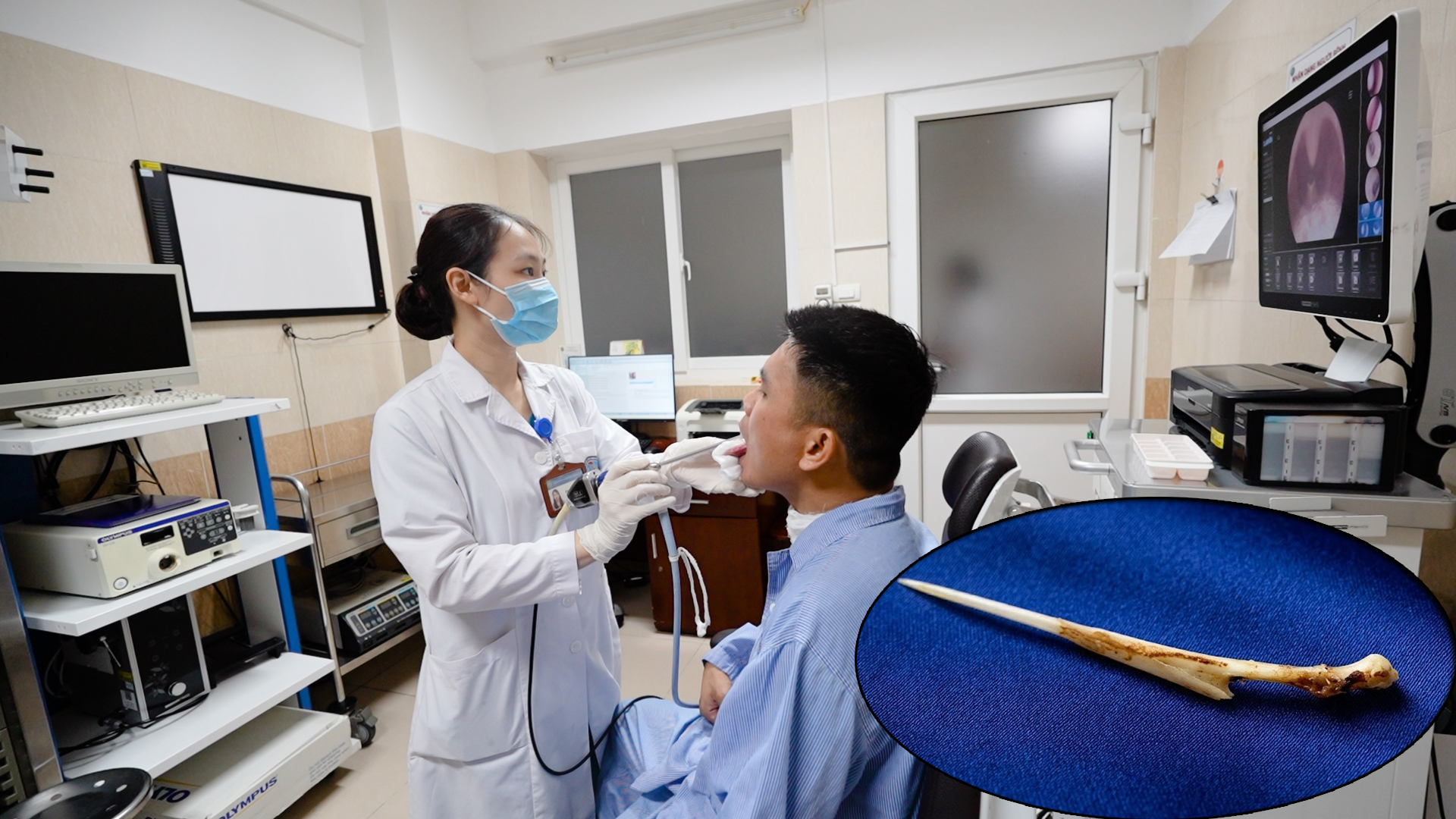 Cố nuốt một miếng cơm để 'chữa mẹo' hóc xương, người đàn ông bị dị vật đâm xuyên qua thực quản - Ảnh 1.