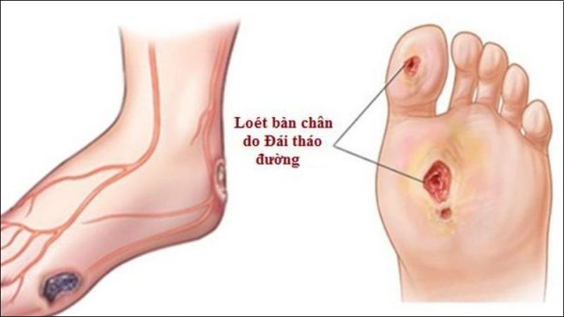 dau-hieu-o-chan-canh-bao-benh-tieu-duong3-800x450-1787316040235-17873160406791064801019