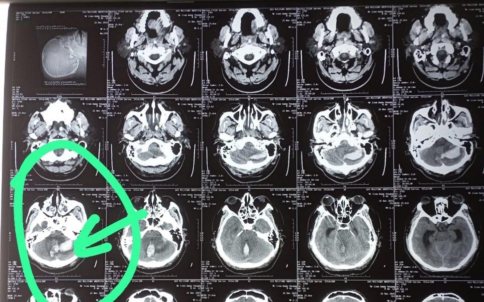 Chuyện Hồi Sinh Kỳ Diệu Của Người Mẹ Lào Sau 8 Tháng Bất Động