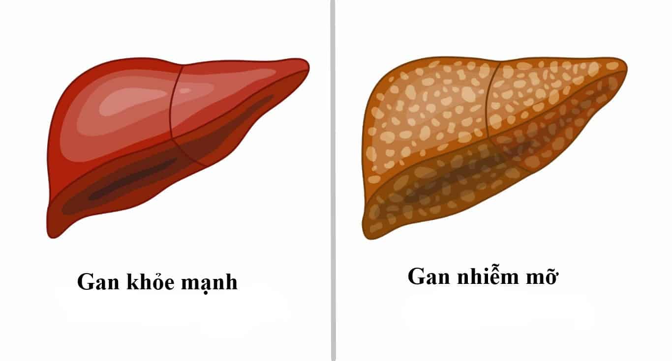 gan-nhiem-mo-17857546508221647976484 Gan nhiễm mỡ: Đừng kỳ vọng chỉ uống thuốc bổ gan là khỏi bệnh - Ảnh 1.