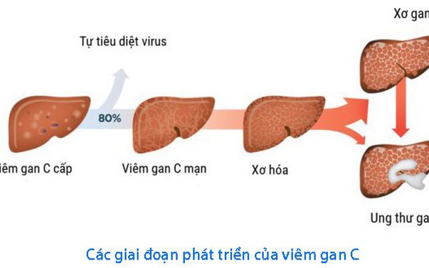 Chặng Đường Loại Trừ Viêm Gan Virus: Thách Thức và Giải Pháp Đến Năm 2030