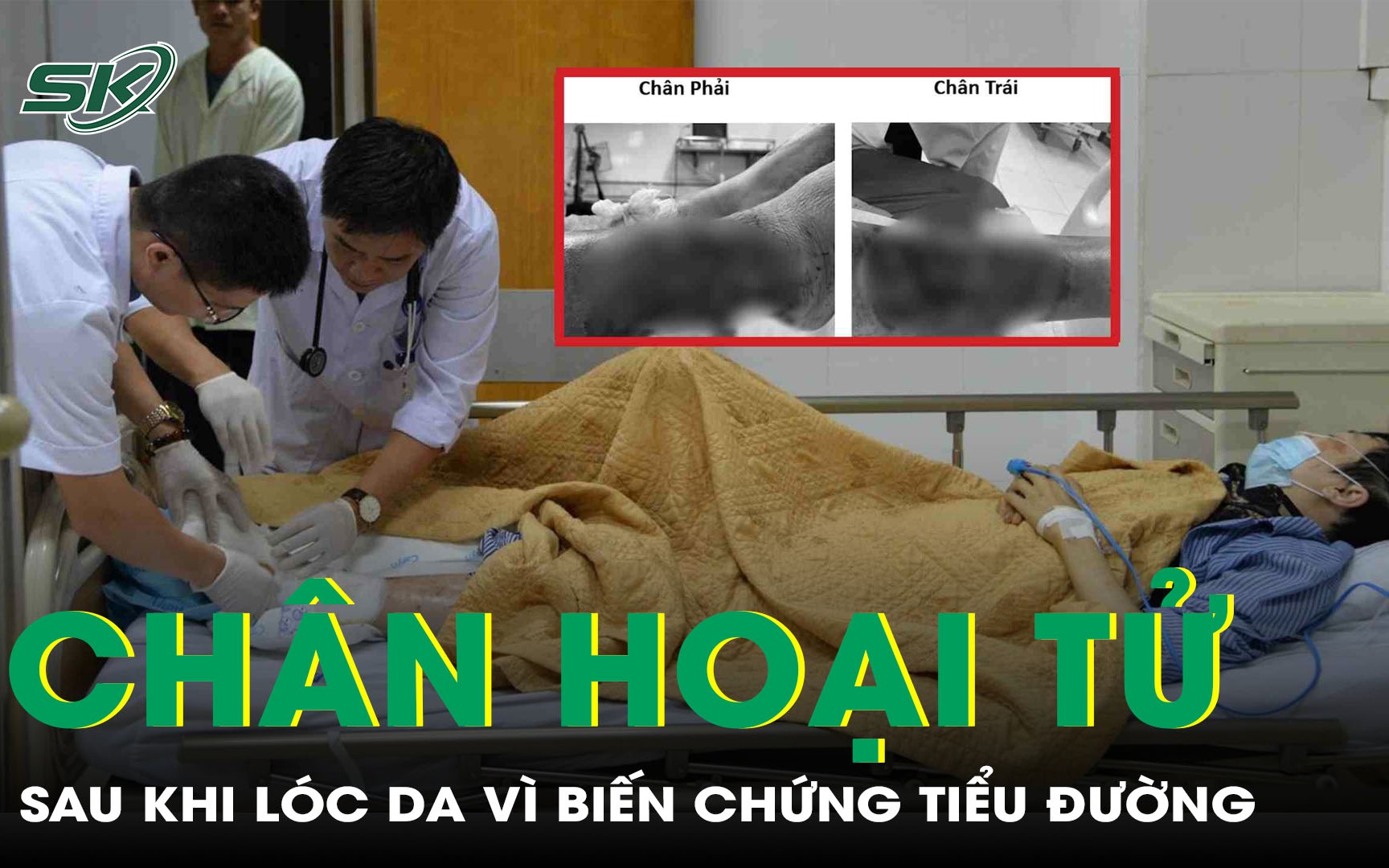 thumb-coapya-dung-17516439794871543201125-0-65-1080-1793-crop-17516439833111231945166 Biến chứng thần kinh do đái tháo đường - Ảnh 1.