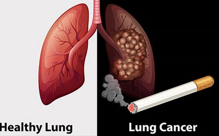Tình Trạng Chẩn Đoán Ung Thư Phổi Tại Việt Nam: Nỗi Lo Muộn Màng