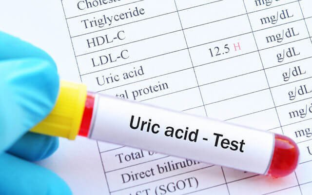 uric-acid-16983106537791692704412-0-0-400-640-crop-17577291099412035271772 Liệu Nước Chanh Mật Ong Có Tác Động Đến Cách Kiểm Soát Acid Uric? - Ảnh 3.