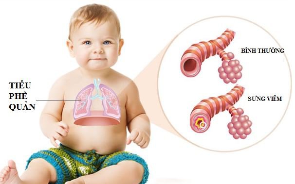 Viêm tiểu phế quản cấp ở trẻ cần phát hiện sớm  - Ảnh 2.