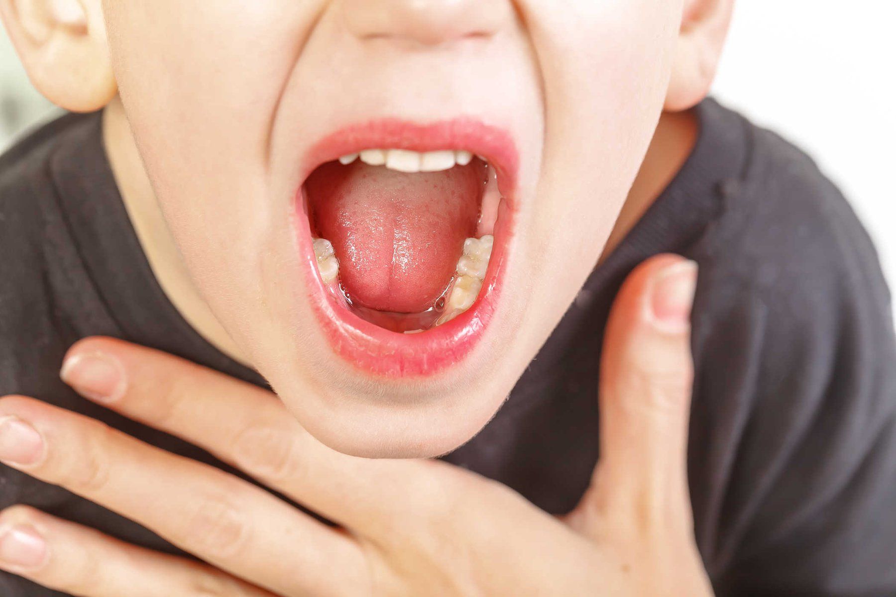Triệu chứng viêm VA cấp tính