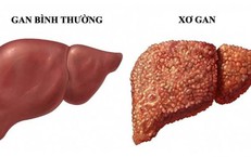 Ảnh Hưởng Của Ca Đêm Đến Sức Khỏe Và Giải Pháp Phòng Ngừa