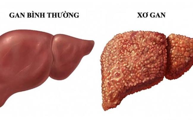 7 Dấu Hiệu Nhận Biết Tổn Thương Gan Cần Lưu Ý