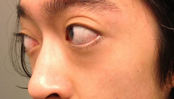 Lồi mắt do bệnh Basedow Lồi mắt do bệnh Basedow